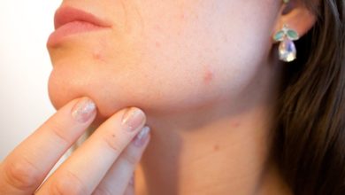 Photo of How to get rid of acne scars: Treatment and Removal